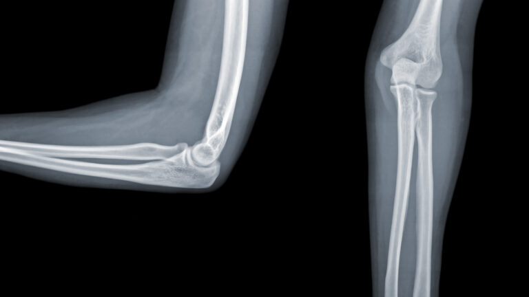 Oyster-Inspired Glue Could Revolutionize Bone Surgery