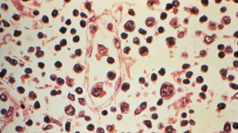What Is Hantavirus—and Why Is It Raising Concern?